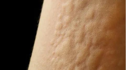 反复发作的*麻疹荨**到底怎么治？标本兼治是良方