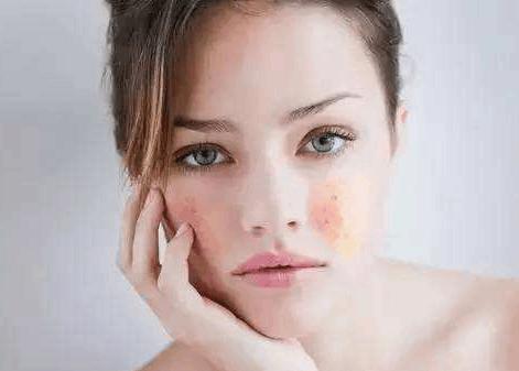 皮肤敏感泛红角质层受损如何修复,改善皮肤泛红敏感肌