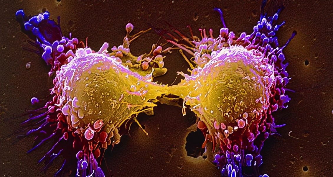 视网膜母细胞瘤是癌症吗,视网膜母细胞瘤为一种恶性肿瘤