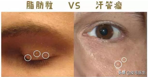 眼霜对眼睛周围小细纹管用吗,去眼上的脂肪颗粒哪一种眼霜好