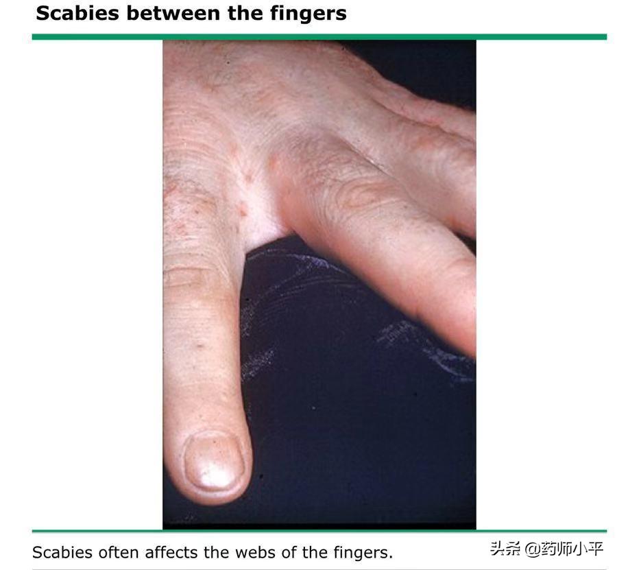 面部发红过敏是什么原因,脸部螨虫过敏起红疹发烫