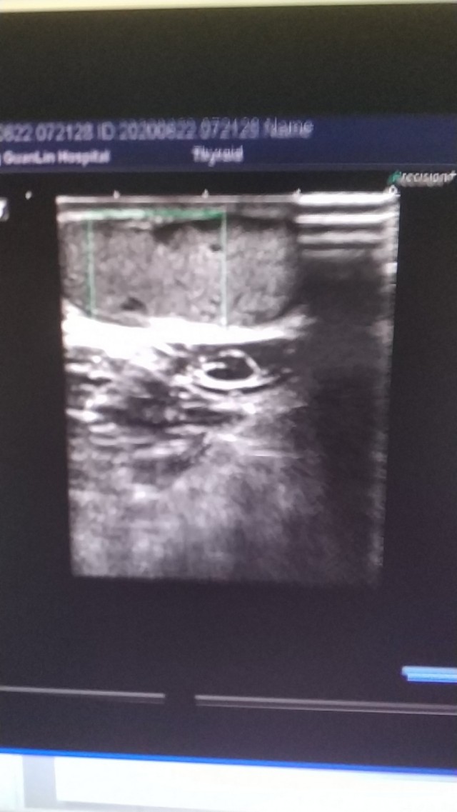 皮脂囊肿简介,皮脂囊肿和脂肪囊肿的区别