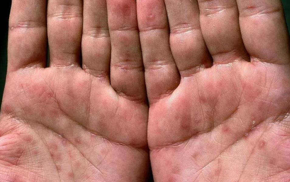 性病有哪些症状？医生：学会自查很重要，教你“望触摸”3个技巧