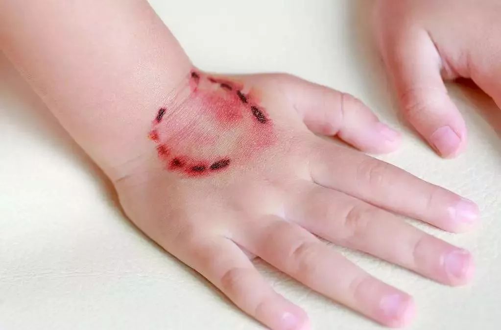 儿童手指夹伤怎么处理,三岁女童手指被压断后续