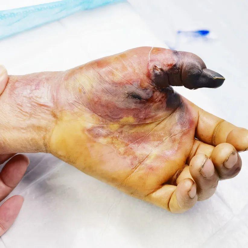 杀鱼被鱼刺刺伤手红肿,大爷杀鱼时鱼刺扎手上中毒身亡