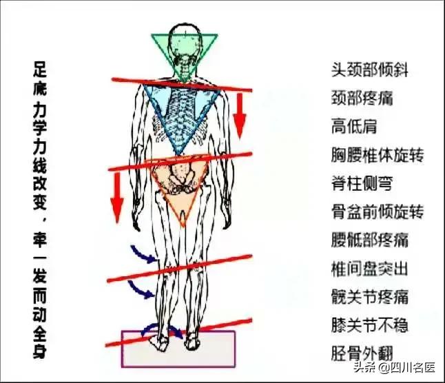 走路扁平足是什么原因,走路脚掌痛是大病前兆