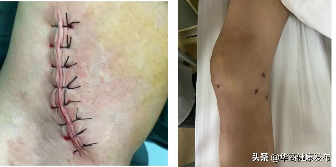 脚膝盖腘窝囊肿手术要注意什么,腘窝囊肿关节镜切除