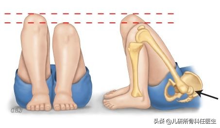 孩子臀纹不对称，看完门诊还是不明白？一次性解答你所有问题