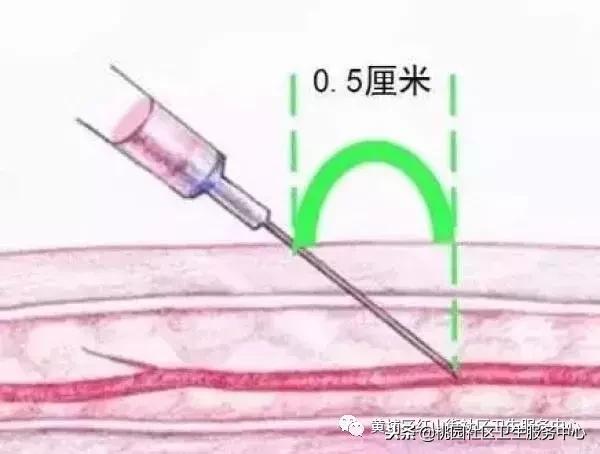 抽血后手臂淤青和护士有关系吗,手臂抽血淤青是护士技术问题吗