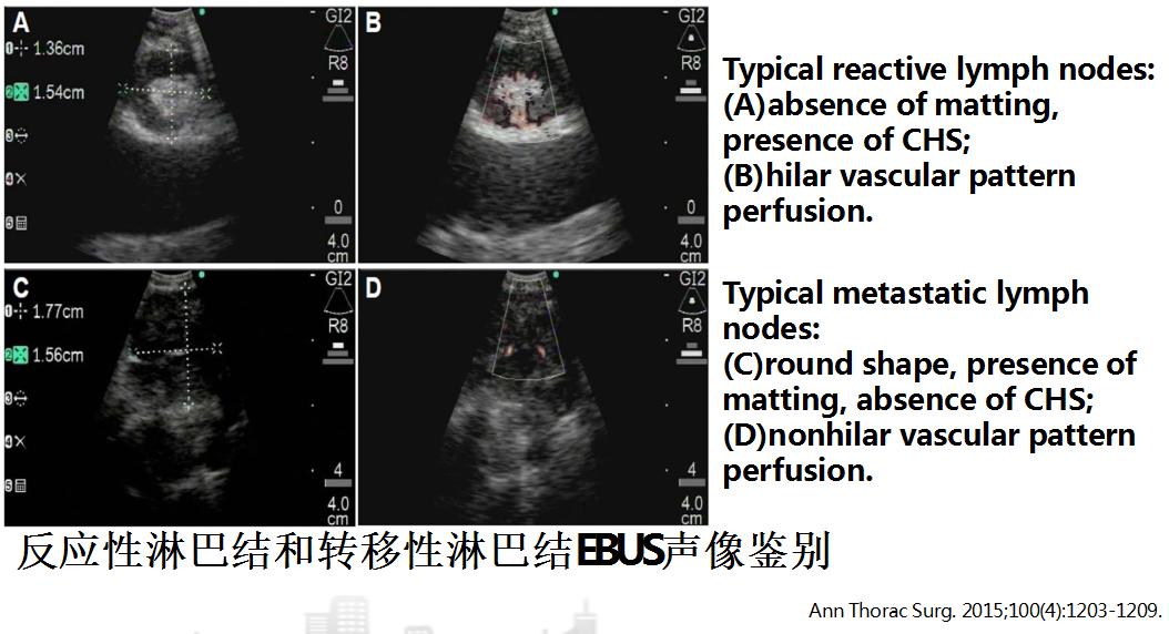 孙加源门诊,治疗肺癌的新技术新手段
