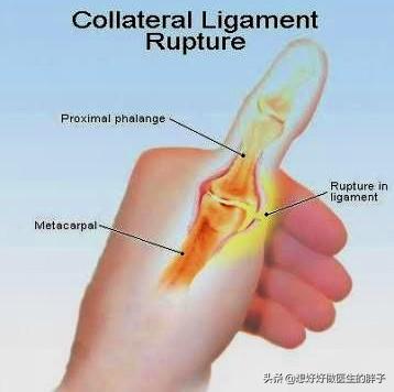 手指打篮球挫伤一个月还没好,手指打篮球挫伤了