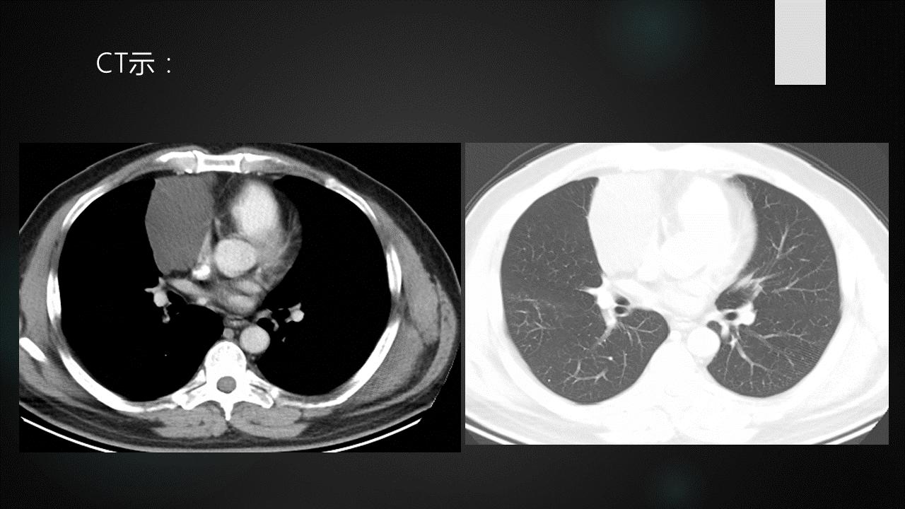 胸腺增生和纵隔肿瘤的区别和症状,纵隔胸腺肿瘤的常见临床症状表现