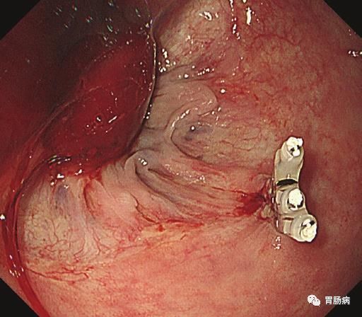 消化道出血的内镜治疗,消化道出血的内镜下治疗