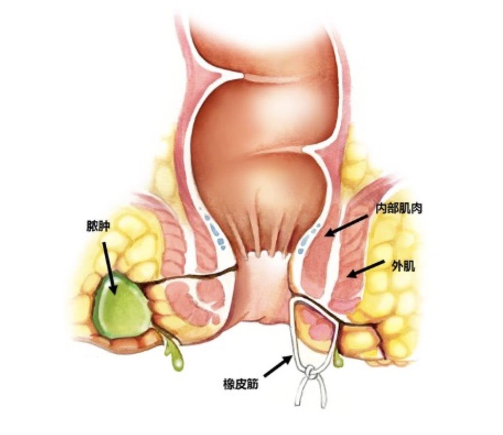 消化内科可以看肛瘘吗,肛瘘挂消化外科可以吗