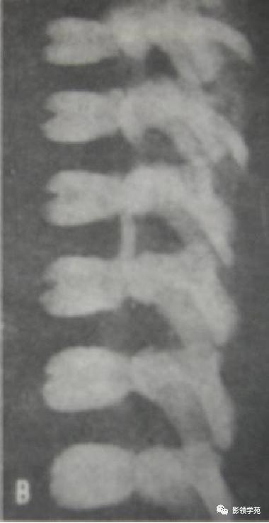 桡骨远端骨折引起尺骨变异,撕脱骨折一个月无明显骨痂形成