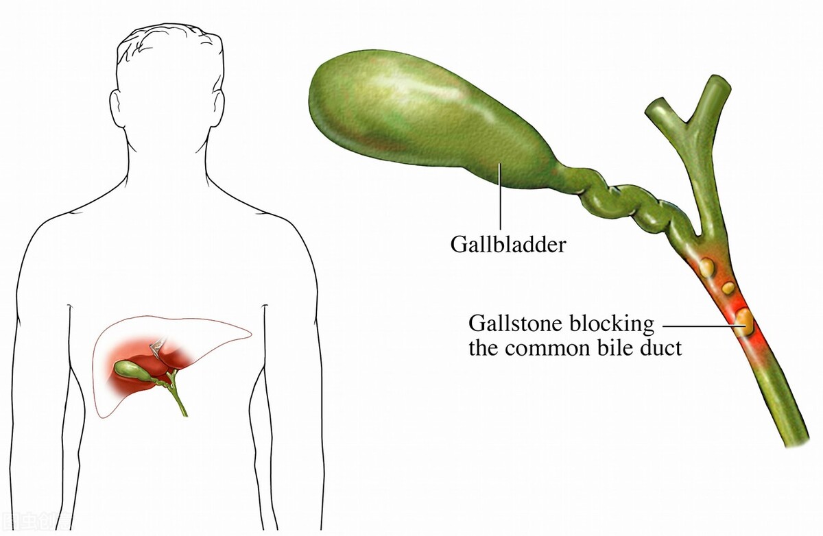 胆囊完全切除了对身体有哪些影响,胆囊重要但是不切不行