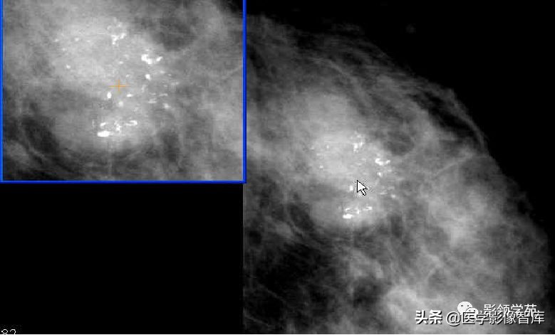 乳腺钙化怎么区分良性和恶性,乳腺钙化的诊断与分级