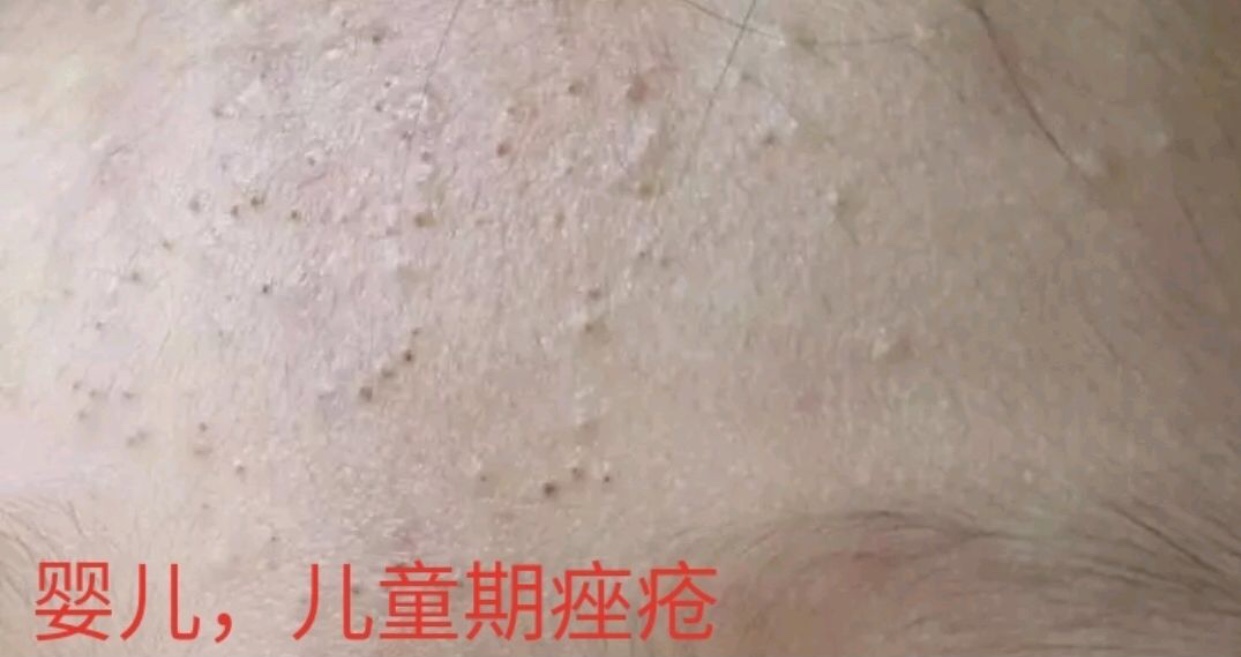 宝宝脂溢性湿疹可以涂什么药膏,宝宝湿疹脂溢性皮炎