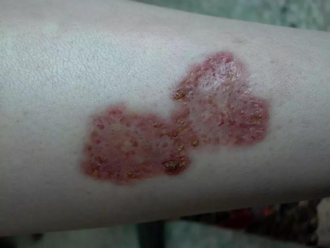 糖友易出现又纠结的8种皮肤病变，医生来支招