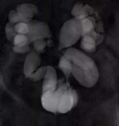 儿童尿频尿急怎么证明是尿路感染,什么原因导致小儿膀胱输尿管反流