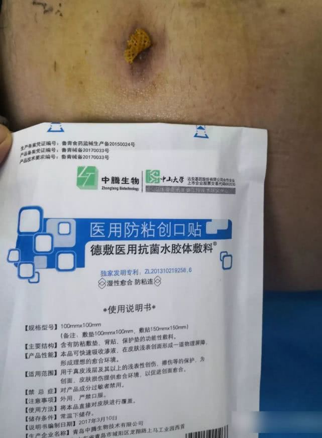 阑尾炎形成窦道的原因,阑尾炎一孔微创手术全过程