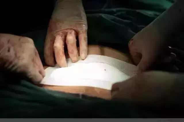 剖腹产术后4小时恢复知觉正常吗,剖腹产术后咳嗽怎样快速恢复