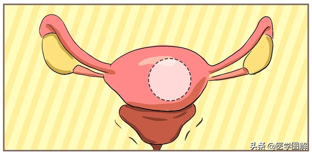 子宫肌瘤，比你想象的可怕！瞬间就危在旦夕？丨医学图解