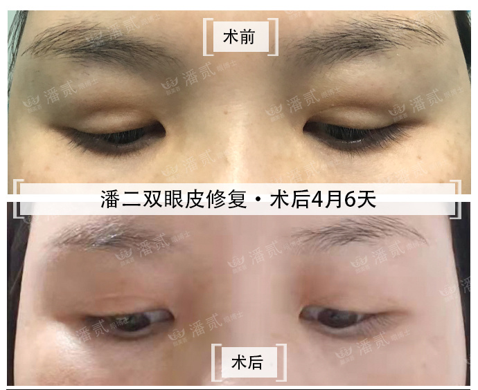 眼皮填充的脂肪凹凸不平怎么办,上眼皮凹陷填充脂肪有危险吗