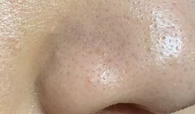 脸上的黑头粉刺挤不出来怎么办,脸部黑头粉刺有必要去美容院挤吗