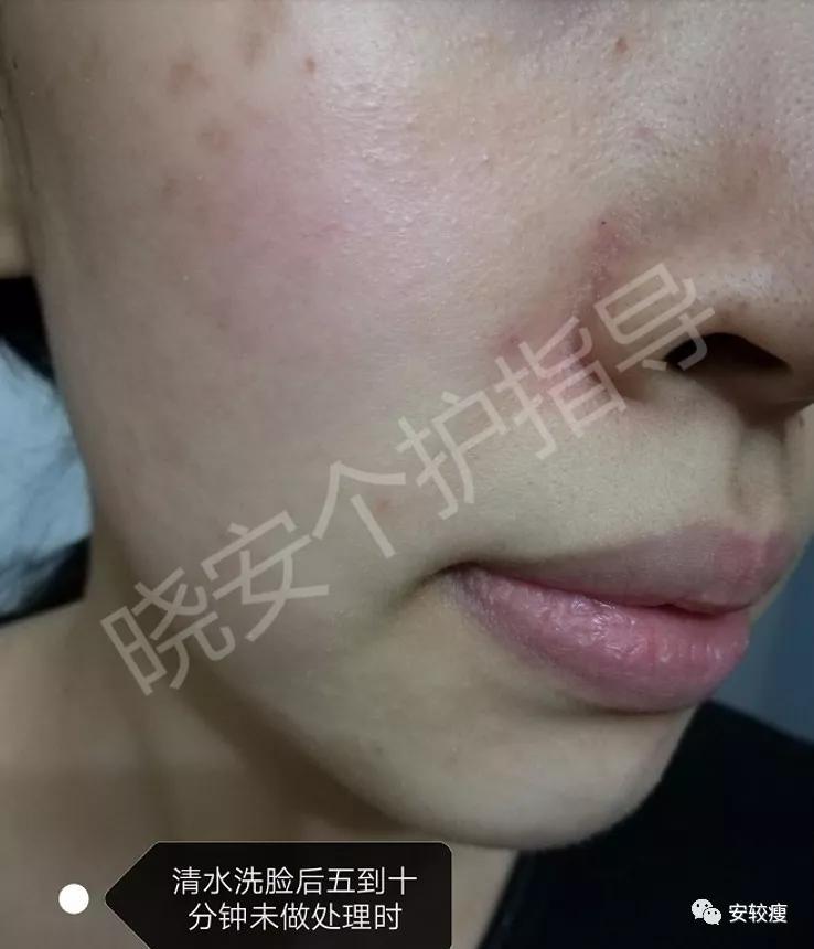 皮炎疹子干燥泛红,秋冬皮肤泛红发烫