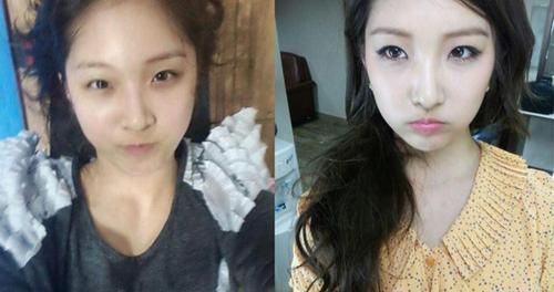 一次脸部微整形换来五年修复路,面部微整形美容前后对比