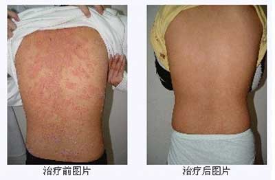 曾国藩的皮肤病是银屑病吗,曾国藩银屑病原因