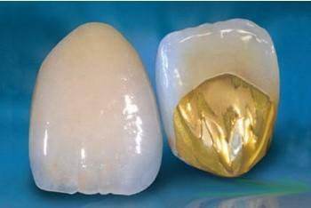 牙冠的常见种类与区别,牙冠什么种类性价比高