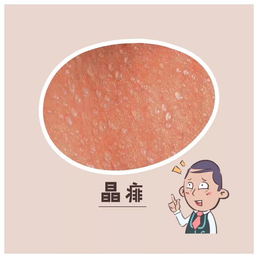 热天痱子怎么治,热天有痱子用什么最好