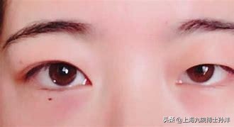 大小眼整形对比图片,大小眼适合什么样的眼部整形