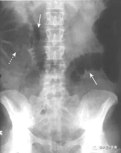 辨识肠梗阻,肠梗阻死亡前兆