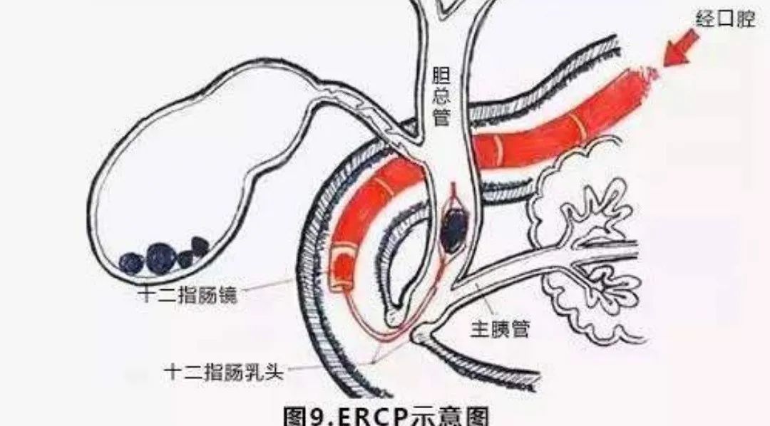 消化内镜技术近5年的新进展,腹腔镜下胆总管切开取石术恢复快