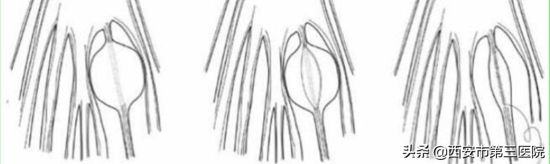 【医者解读】揭开“骶管囊肿”之神秘面纱，查出骶管囊肿都需要治疗吗？（手术病例+文献回顾）