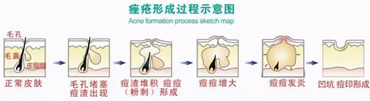 战痘神器工具,长痘男士必知的祛痘神器