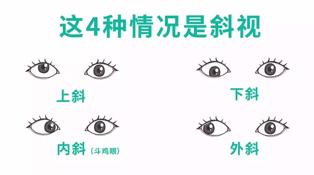 斜视该怎么办,眼睛斜视好治吗多长时间能治好