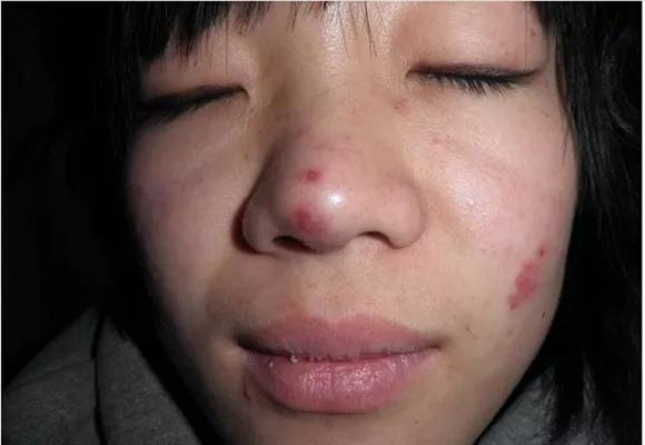 皮肤科红斑狼疮,中医能治皮肤红斑狼疮吗