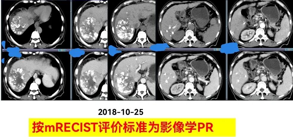 肝癌晚期靶向治疗怎么做,中国肝癌tace治疗展望