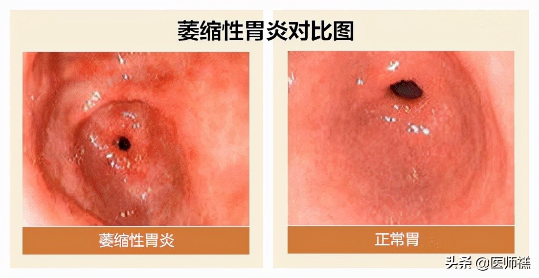 胃炎久治不愈查肿瘤标志物正常,胃炎一直拖着不治