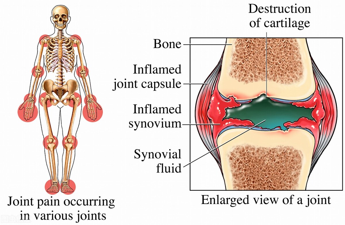 关节炎非甾体类消炎止痛药,非甾体类抗炎止痛药的禁忌