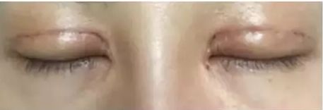 割双眼皮没有忌口有疤痕怎么办,割双眼皮疤痕明显怎么办