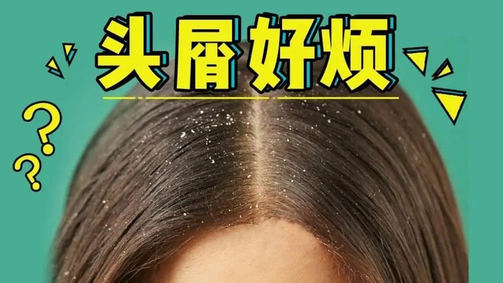 脂溢性皮炎头皮一定有头皮屑吗,脂溢性头皮屑有多难治