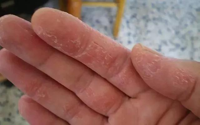 澳洲顶级护脚膏,凡士林手足防裂膏妈妈用