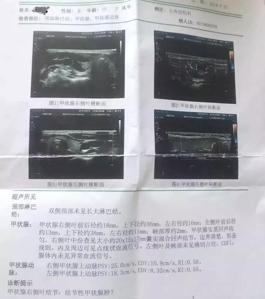 甲状腺结节患者真实案例视频,如何判断甲状腺结节癌变是早期