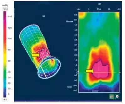 肛肠科：直肠前突是造成便秘的主要因素之一！