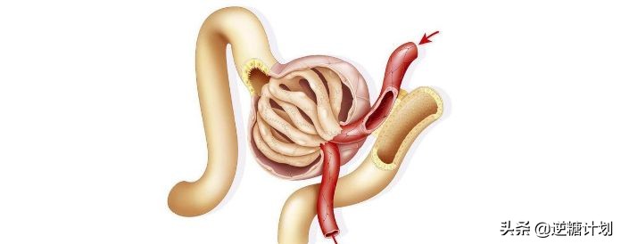 低碳饮食引起痛风能恢复吗,低碳饮食尿酸升高会痛风么